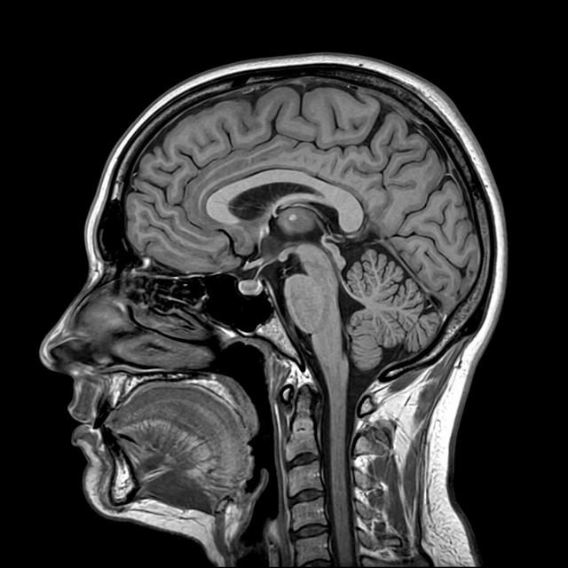 Sagittal MRI Brain Slice